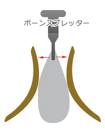 骨がうすい場合のインプラント治療
