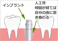 少しホールを形成し隙間を人工骨で埋める