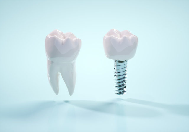 抜歯即時インプラント